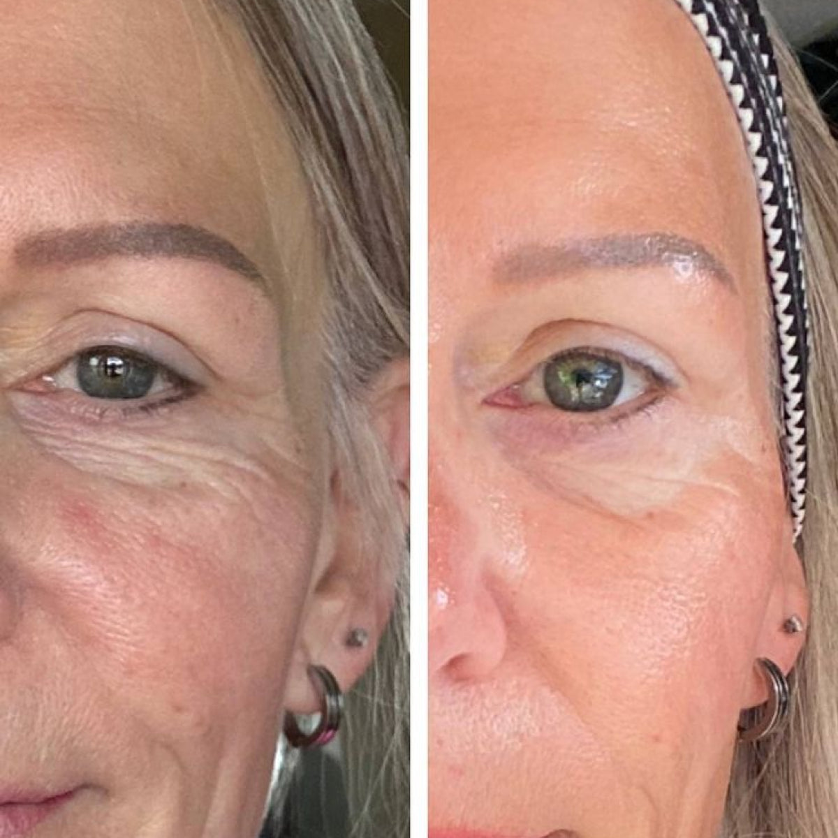 Instaglow Micro Infusion Kit