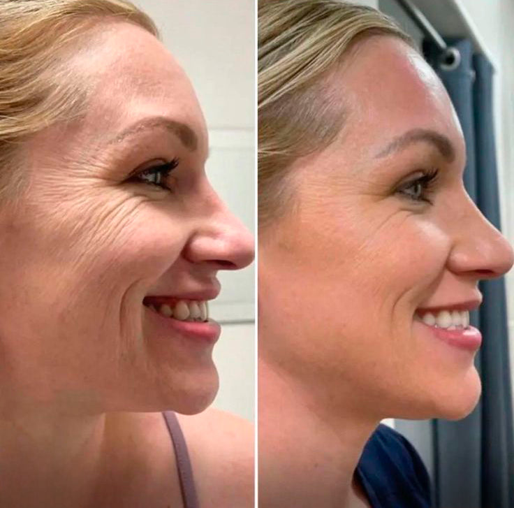 Instaglow Micro Infusion Kit